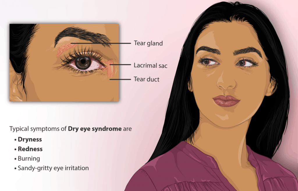 Dry Eyes Symptoms